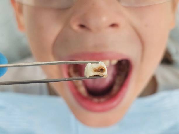 Best Emergency Treatment for Dental Infections or Abscesses in Manson, WA